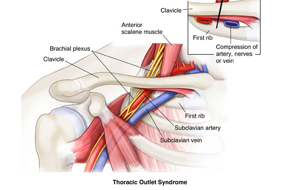 TOS Thoracic Outlet Syndrome